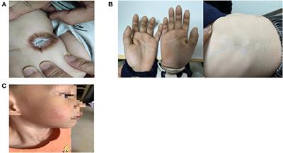 Case report: Compound heterozygous mutations in the KDSR gene cause progressive keratodermia and thrombocytopenia